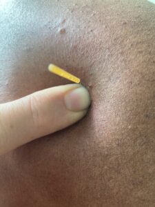 dry Needling