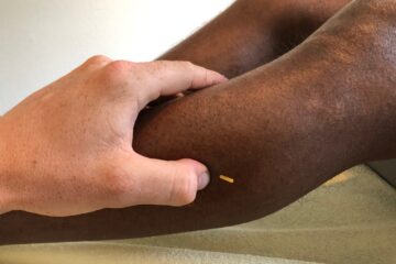 Dry Needling Zürich: Schmerzfrei mit Physiotherapie Waidfuss