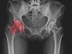 Arthrose: Warum Bewegung die beste Medizin bei Gelenkverschleiss ist Hüftarthrose, Arthrose: Warum Bewegung die beste Medizin bei Gelenkverschleiss ist