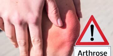 Arthrose