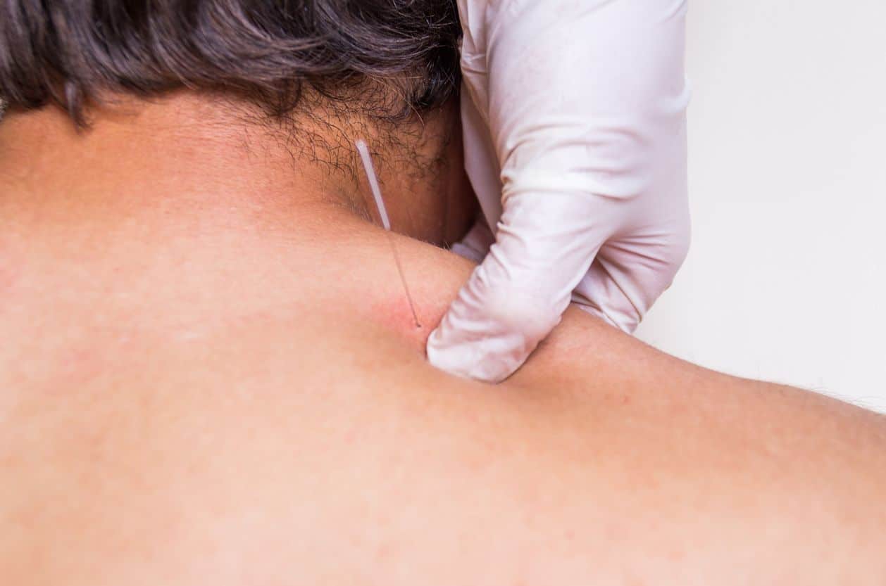 Dry Needling on the Neck: Needle in the Trigger Point of the Shoulder Muscles, Physio Waidfuss Zürich Wipkingen