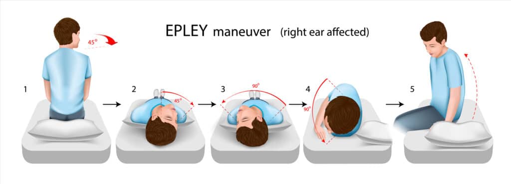 Epley maneuver: storage maneuver in 5 steps in storage dizziness (BPLS)